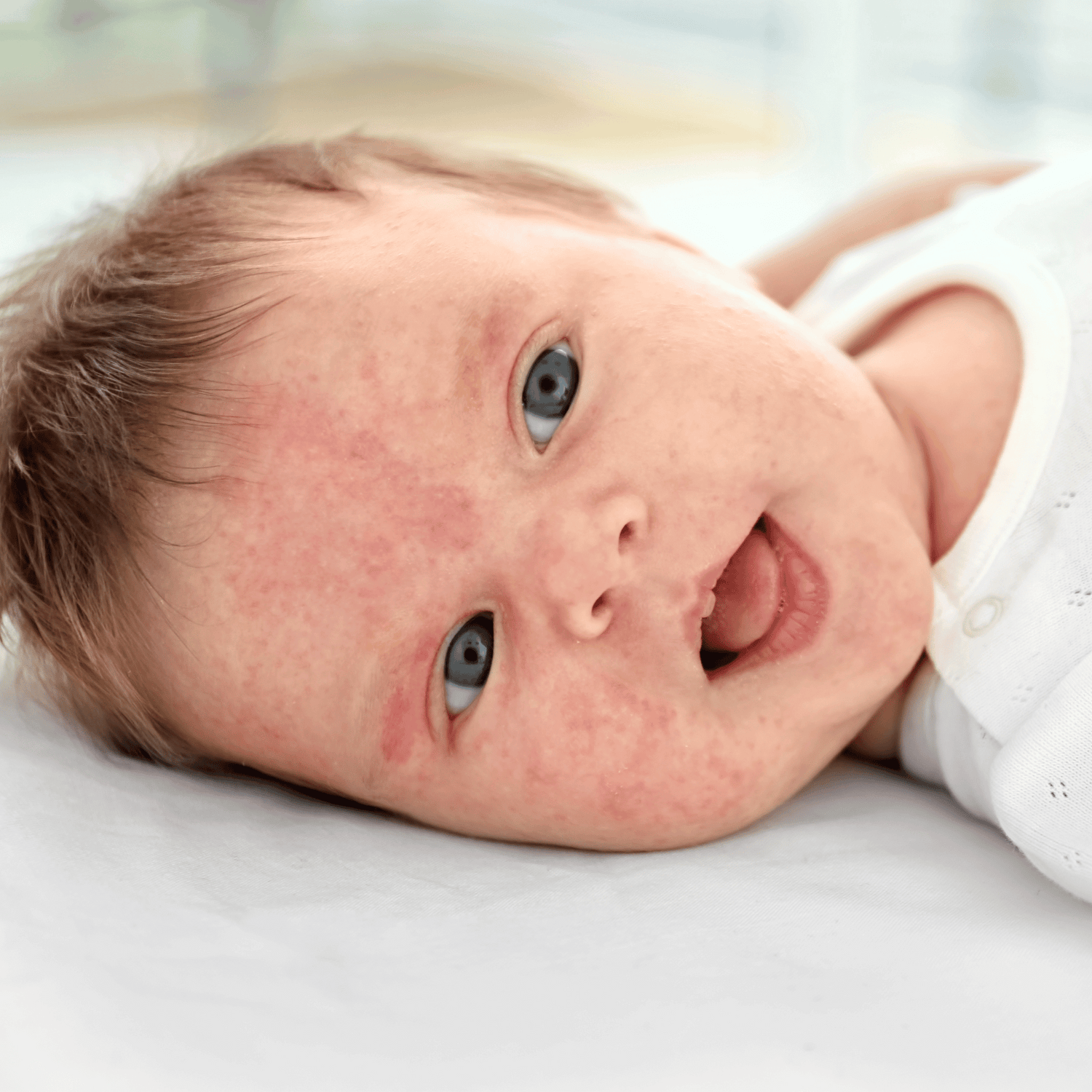 Eczeem in gezicht van baby