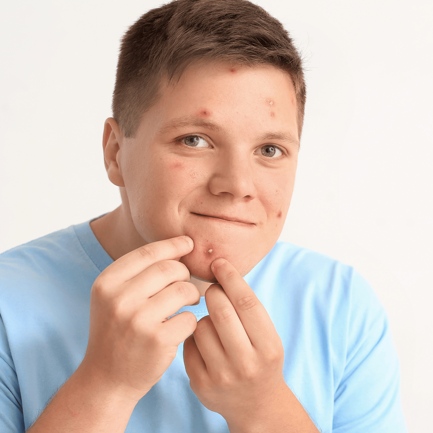 Jongeman met puistjes en acne in gezicht.