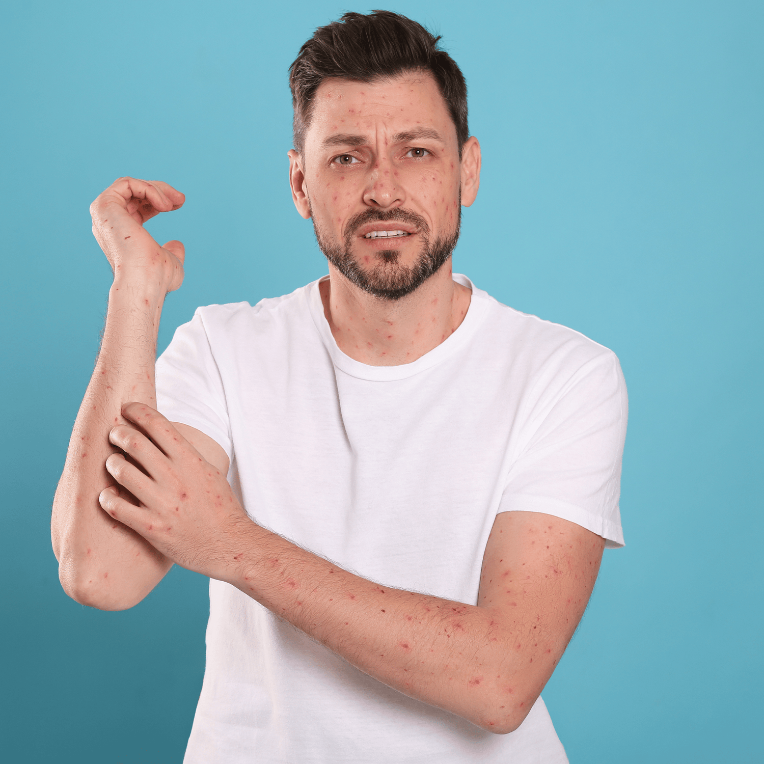 Man onder de muggenbulten. Krapt aan arm.