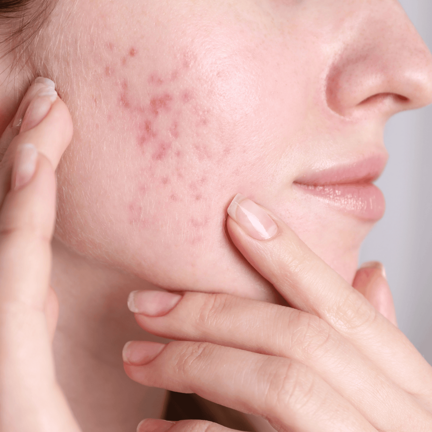 Vrouw met acne op haar wang.