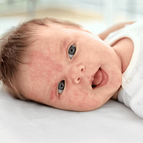 Eczeem bij kinderen en volwassenen