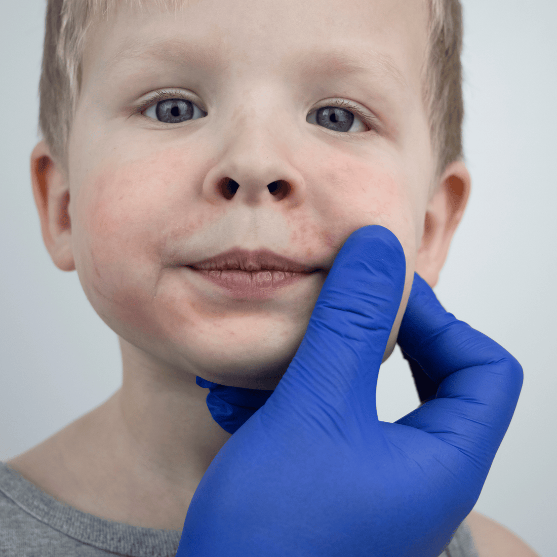 Eczeem bij kinderen: nek, gezicht & ellebogen behandelen