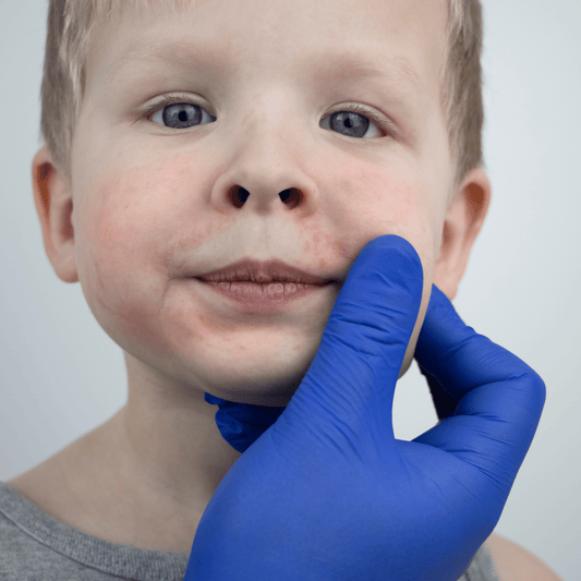 Eczeem bij kinderen: nek, gezicht & ellebogen behandelen