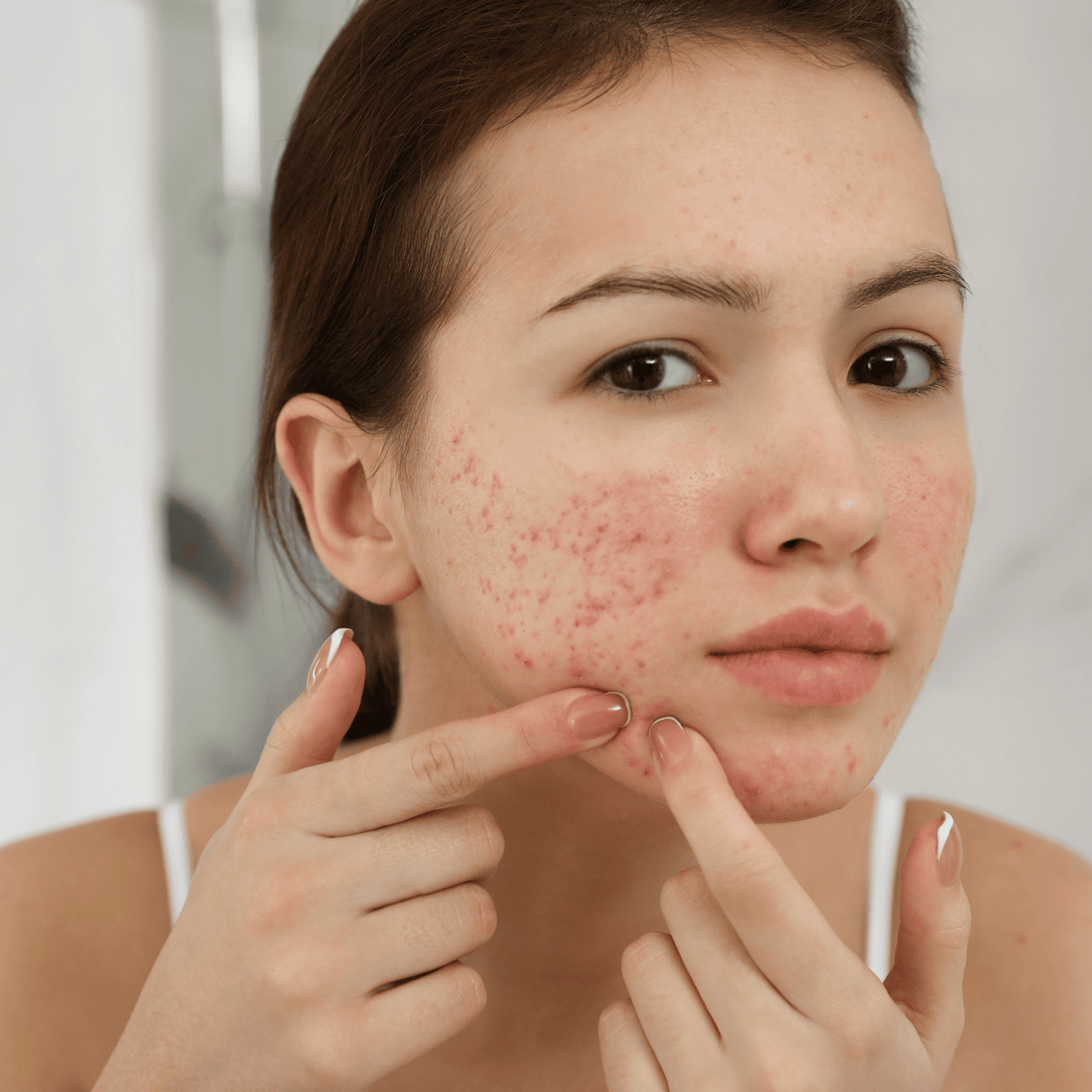 Acne behandelen met Aleppo zeep