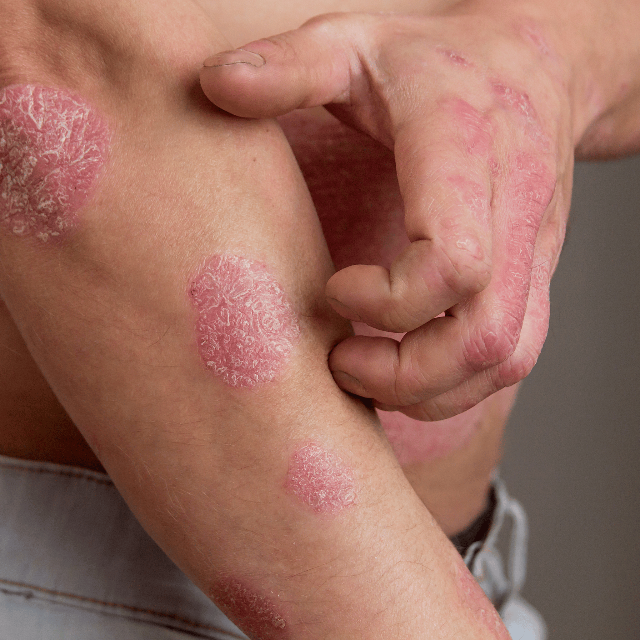 Eczeem op arm en hand van man